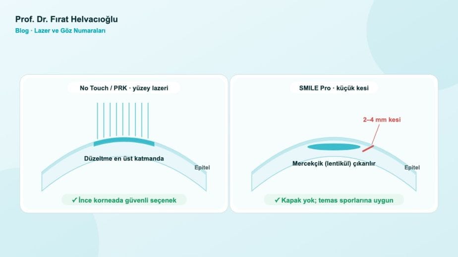 Yüzey lazeri ve SMILE Pro yönteminin korneada çalıştığı katmanlar – Prof. Dr. Fırat Helvacıoğlu