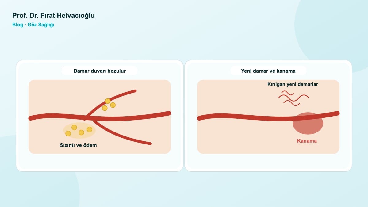 Şeker Hastalığı Gözünüzü Nasıl Etkiler? – Prof. Dr. Fırat Helvacıoğlu
