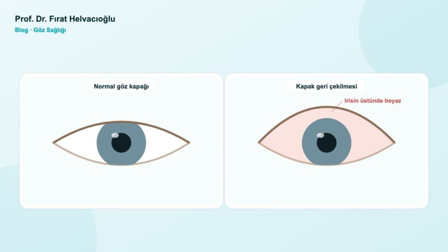 Tiroid Gözünüzü Etkileyebilir: Belirtiler ve Tedavi – Prof. Dr. Fırat Helvacıoğlu