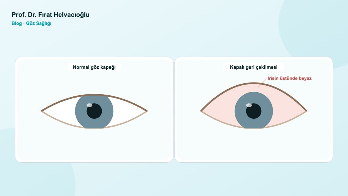Tiroid Gözünüzü Etkileyebilir: Belirtiler ve Tedavi – Prof. Dr. Fırat Helvacıoğlu