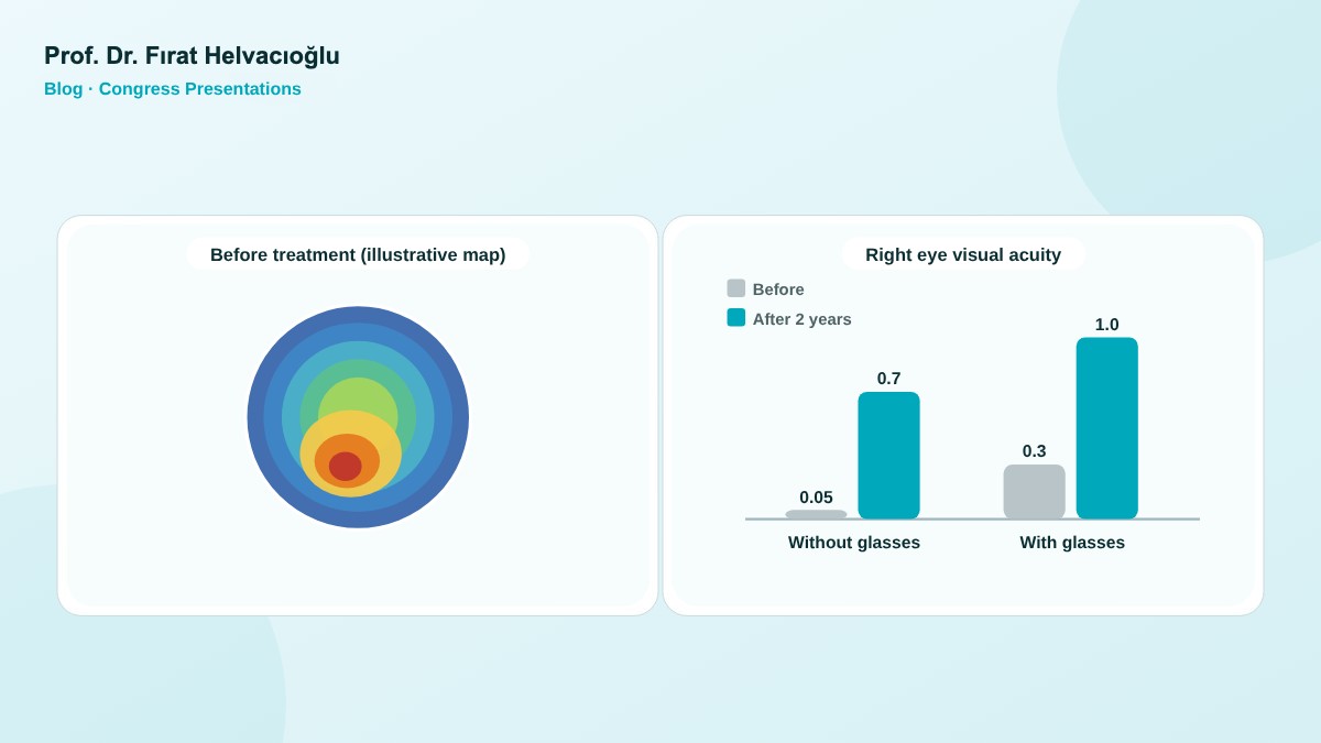 Keratoconus hybride behandeling: persoonlijke oppervlaktelaser en cross-linking – Prof. Dr. Fırat Helvacıoğlu